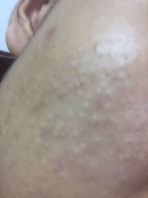 脸上痣不断长大，脸上长痣慢慢长大是什么 