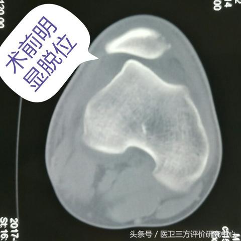 小腿疤痕不断脱落，小腿上疤痕多是怎么回事儿 